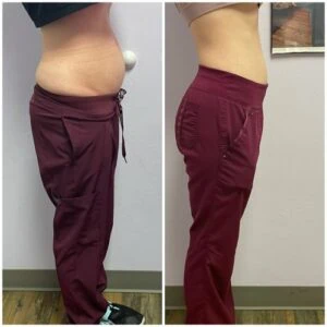 Monopolar Rf Before and After results at Petra's Weightloss Clinic Med Spa in Oklahoma City, OK