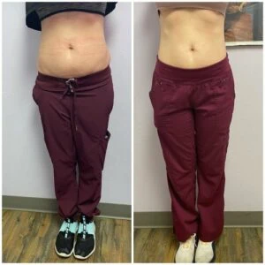 Monopolar Rf Before and After results at Petra's Weightloss Clinic Med Spa in Oklahoma City, OK