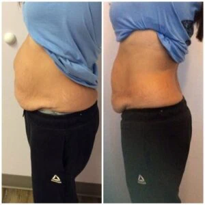 Monopolar Rf Before and After results at Petra's Weightloss Clinic Med Spa in Oklahoma City, OK