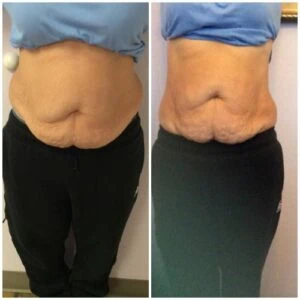 Monopolar Rf Before and After results at Petra's Weightloss Clinic Med Spa in Oklahoma City, OK