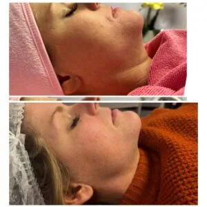 Monopolar Rf Before and After results at Petra's Weightloss Clinic Med Spa in Oklahoma City, OK