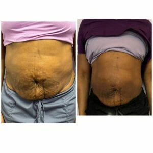 Monopolar Rf Before and After results at Petra's Weightloss Clinic Med Spa in Oklahoma City, OK