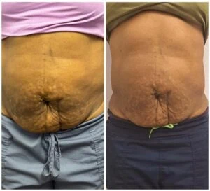 Monopolar Rf Before and After results at Petra's Weightloss Clinic Med Spa in Oklahoma City, OK
