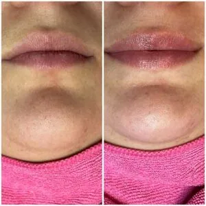Lip Filler treatment Before and After results at Petra's Weightloss Clinic Med Spa in Oklahoma City, OK