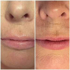 Lip Filler treatment Before and After results at Petra's Weightloss Clinic Med Spa in Oklahoma City, OK