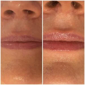 Lip Filler treatment Before and After results at Petra's Weightloss Clinic Med Spa in Oklahoma City, OK