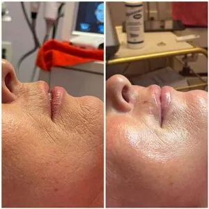 Lip Filler treatment Before and After results at Petra's Weightloss Clinic Med Spa in Oklahoma City, OK
