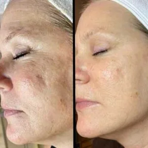Woman Before and After Procell Microchanneling A