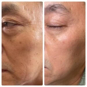 Woman Before and After Procell Microchanneling B