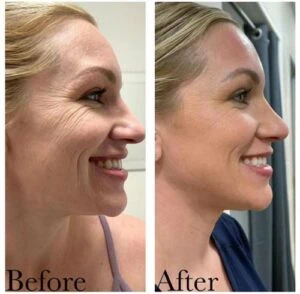 Woman Before and After Procell Microchanneling C