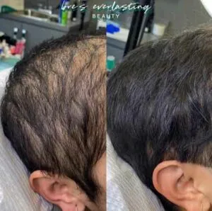 Woman Before and After Procell Microchanneling D