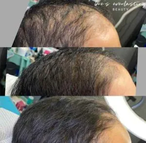 Woman Before and After Procell Microchanneling E