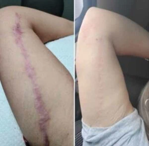 Woman Before and After Procell Microchanneling F