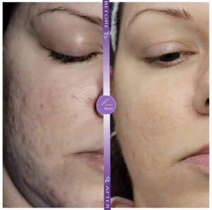 Woman Before and After Procell Microchanneling G