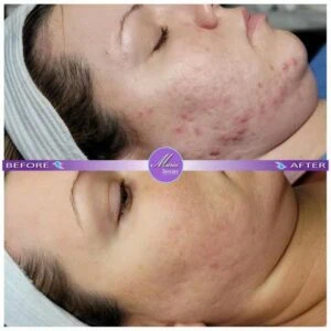Woman Before and After Procell Microchanneling H
