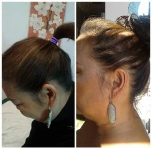 Woman Before and After Procell Microchanneling i