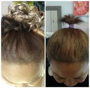 Woman Before and After Procell Microchanneling J