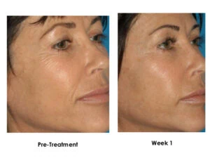 Woman Before and After Procell Microchanneling I