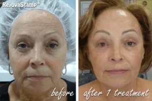 Woman Before and After Procell Microchanneling M