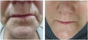 Woman Before and After Procell Microchanneling N