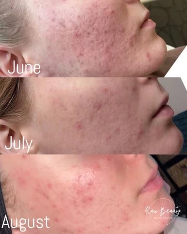 Woman Before and After Procell Microchanneling O