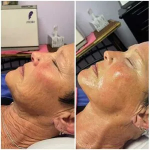 Woman Before and After Procell Microchanneling P