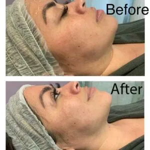 Woman Before and After Procell Microchanneling Q