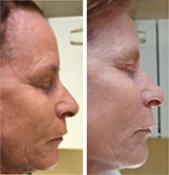 Man Before and After Procell Microchanneling R