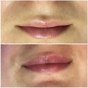 Man Before and After Procell Microchanneling S