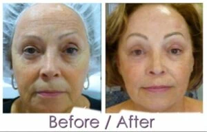 Woman Before and After Procell Microchanneling T