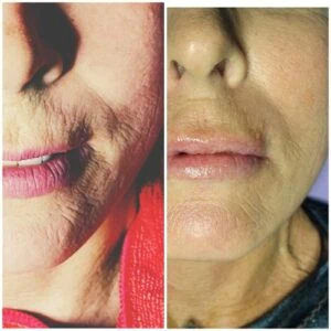 Before and After Procell Microchanneling