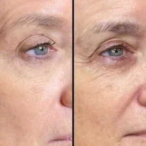 Woman Before and After Procell Microchanneling