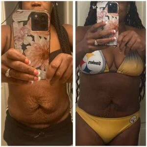 RF Microneedling Before and After results at Petra's Weightloss Clinic Med Spa in Oklahoma City, OK