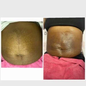 RF Microneedling Before and After results at Petra's Weightloss Clinic Med Spa in Oklahoma City, OK