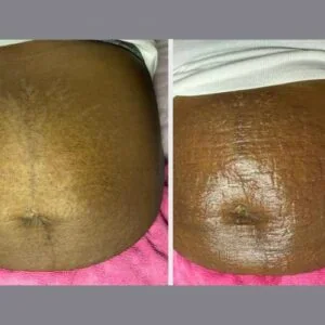 RF Microneedling Before and After results at Petra's Weightloss Clinic Med Spa in Oklahoma City, OK