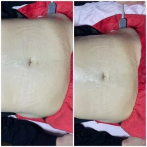 RF Microneedling Before and After results at Petra's Weightloss Clinic Med Spa in Oklahoma City, OK
