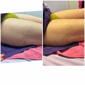 RF Microneedling Before and After results at Petra's Weightloss Clinic Med Spa in Oklahoma City, OK