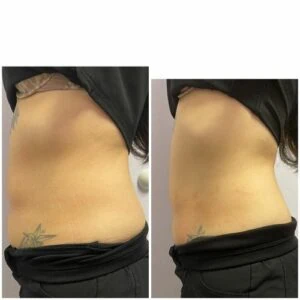 RF Microneedling Before and After results at Petra's Weightloss Clinic Med Spa in Oklahoma City, OK