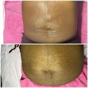 RF Microneedling Before and After results at Petra's Weightloss Clinic Med Spa in Oklahoma City, OK