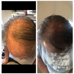 Stem Cells treatment for hair Before and After results at Petra's Weightloss Clinic Med Spa in Oklahoma City, OK