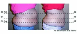 Woman Before and After Vevazz Laser Light Lipo Therapy i