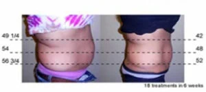 Woman Before and After Vevazz Laser Light Lipo Therapy J