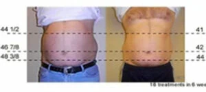 Woman Before and After Vevazz Laser Light Lipo Therapy K