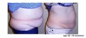 Woman Before and After Vevazz Laser Light Lipo Therapy L