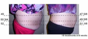 Woman Before and After Vevazz Laser Light Lipo Therapy M