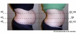 Woman Before and After Vevazz Laser Light Lipo Therapy N