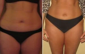 Woman Before and After Vevazz Laser Light Lipo Therapy O