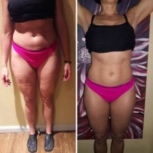 Woman Before and After Vevazz Laser Light Lipo Therapy P