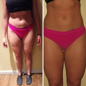 Woman Before and After Vevazz Laser Light Lipo Therapy Q