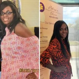 Woman Before and After Vevazz Laser Light Lipo Therapy R